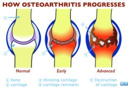 How Osteoarthritis progresses when our number of adult stem cells is low