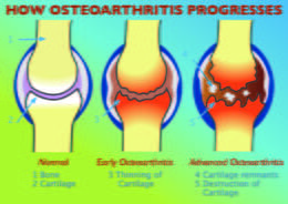 how osteoarthritis develops