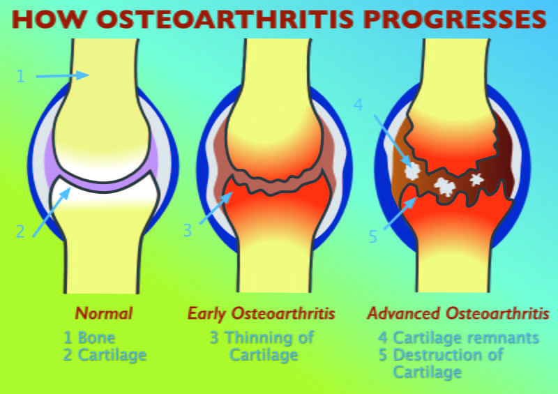 how osteoarthritis develops in joints from normal joint through early and advanced stages of osteoarthritis